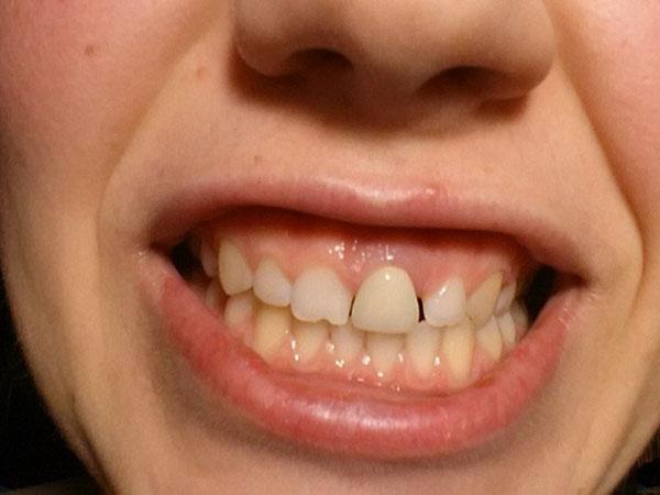 Болит зуб под коронкой: причины и как снять боль — ROOTT