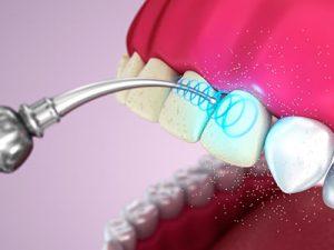 Профессиональная чистка зубов ультразвуком